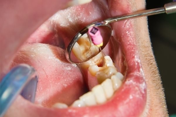 tratamento-endodontico